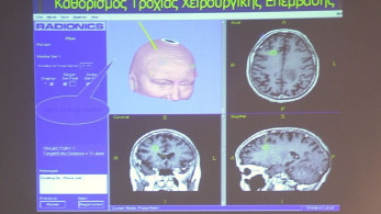 Έως το 2040, η νόσος Πάρκινσον θα έχει ξεπεράσει σε συχνότητα εμφάνισης τον καρκίνο